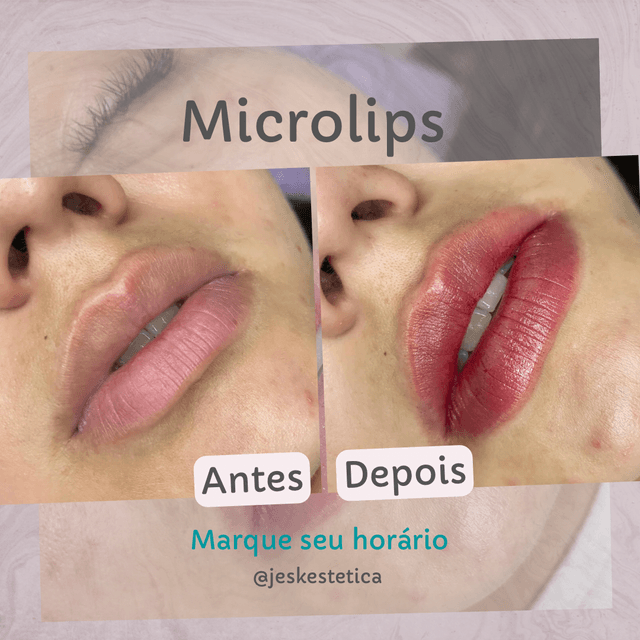 Microlips